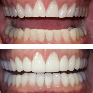 Joy Before & After Treatment
